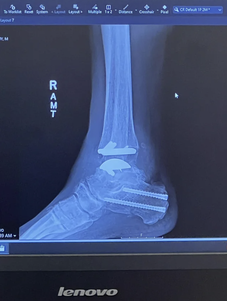 My artificial right ankle, with surgical screws in my heel.