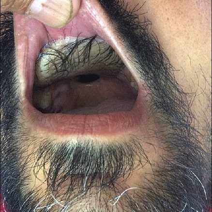 hair growing in the mouth