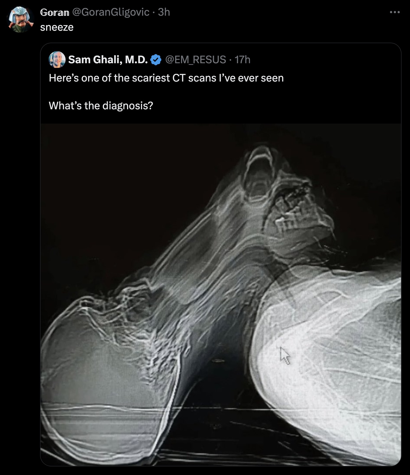 panicking during ct scan - Goran 3h sneeze O Sam Ghali, M.D. 17h Here's one of the scariest Ct scans I've ever seen What's the diagnosis?