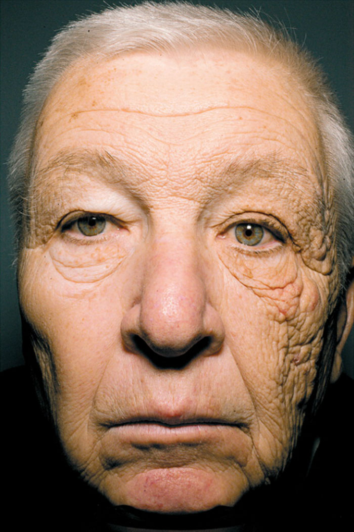 A delivery driver's face after 28 years of driving. The sun damage to the side of his face that was in the sun vs. the side that was in the shade.