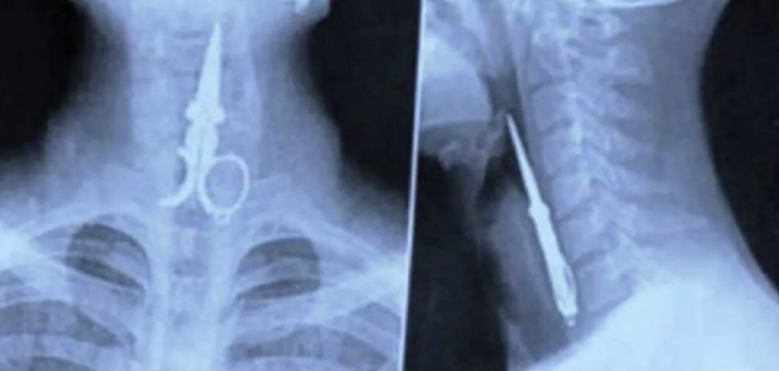 swallowed nails in xray