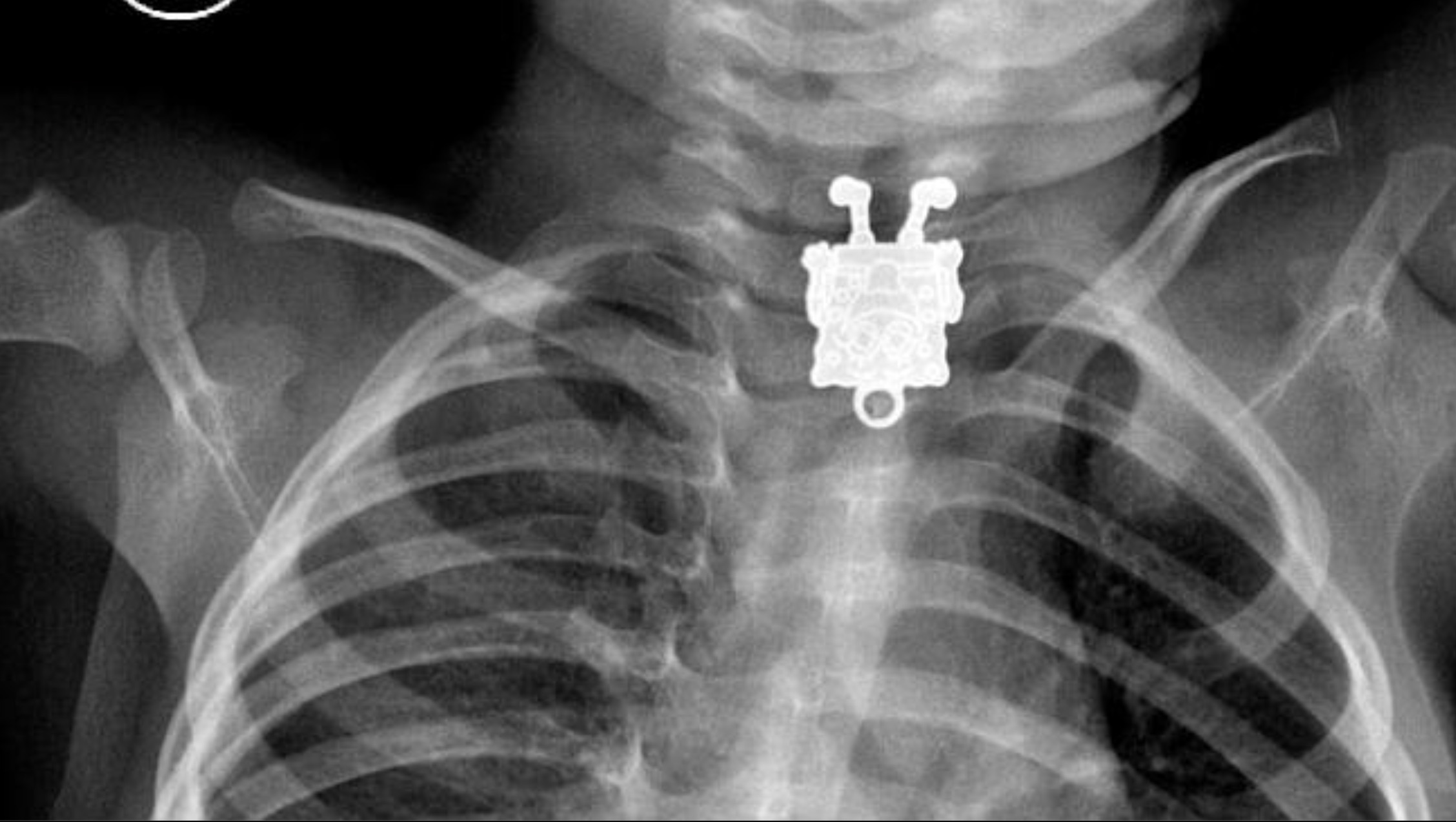 25 Crazy Things Seen in X-Rays