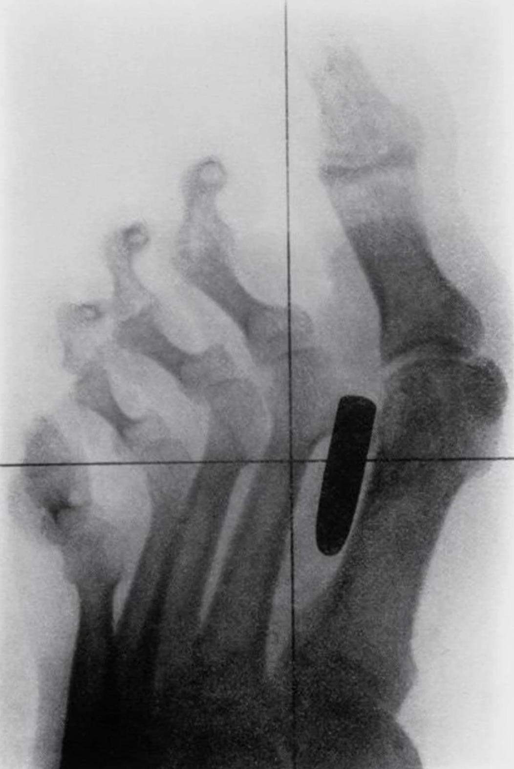 X-ray