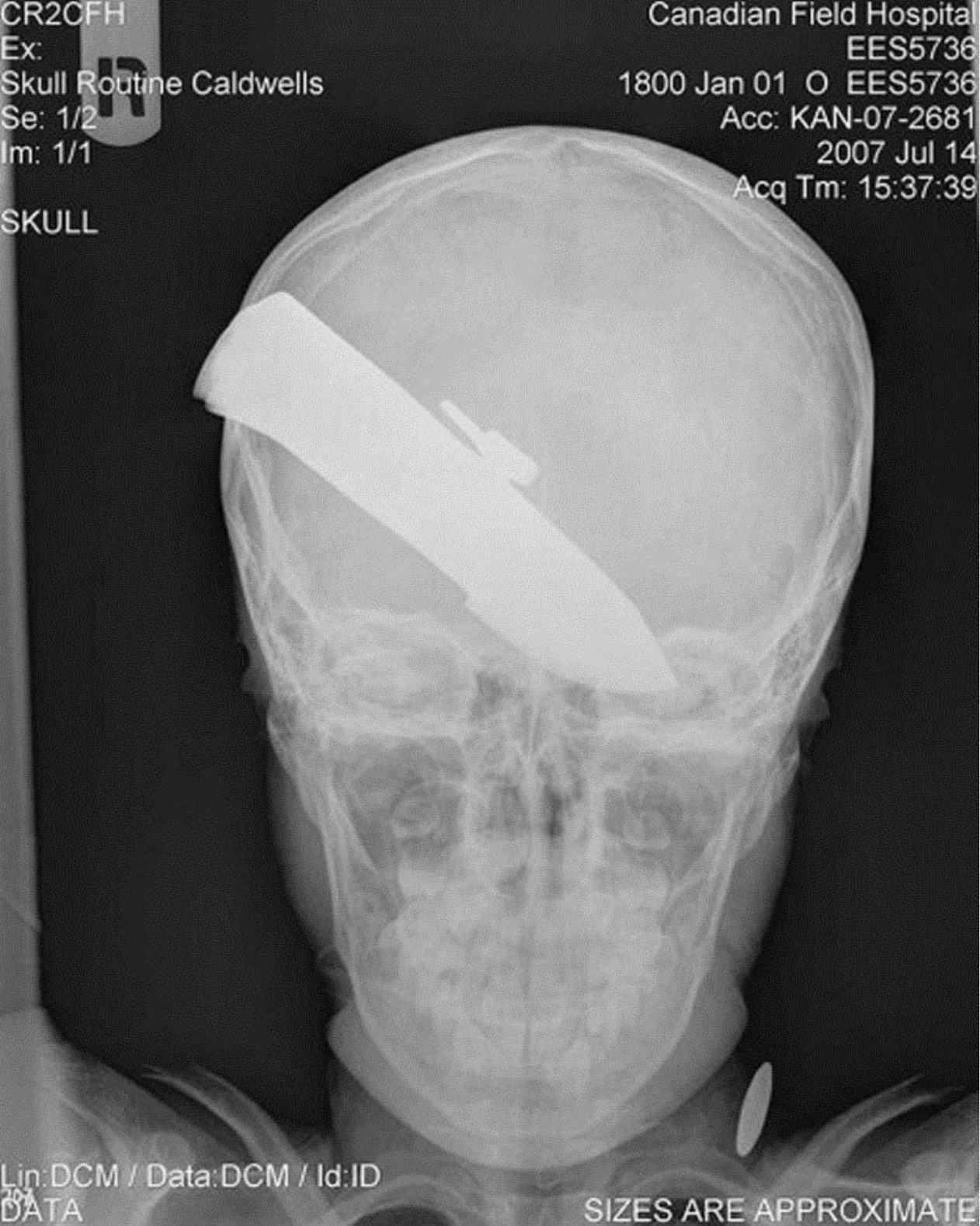 X-ray - CR2CFH Ex Skull Routine Caldwells Se 12 Im 11 Skull Canadian Field Hospital EES5736 1800 Jan 01 O EES5736 Acc Kan072681 2007 Jul 14 Acq Tm 39 Lin DcmData Dcm Id Id Data Sizes Are Approximate