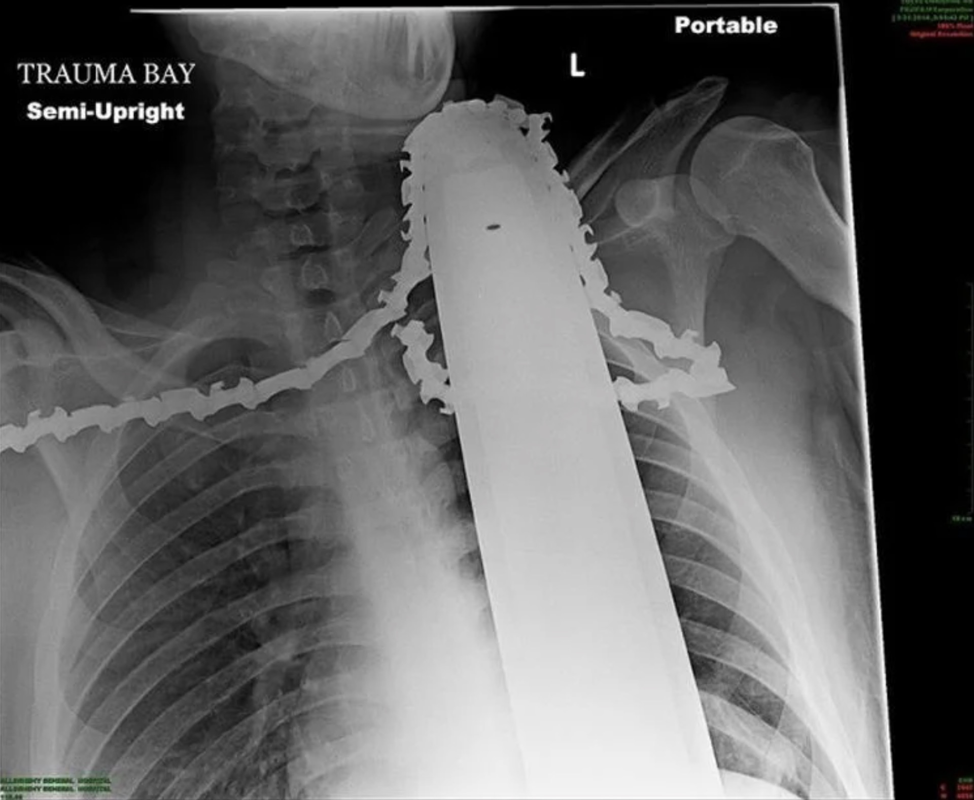 Trauma Bay SemiUpright Ledky Bohemal Wo Loriday Echeral Worn L Portable 9 1647 4834