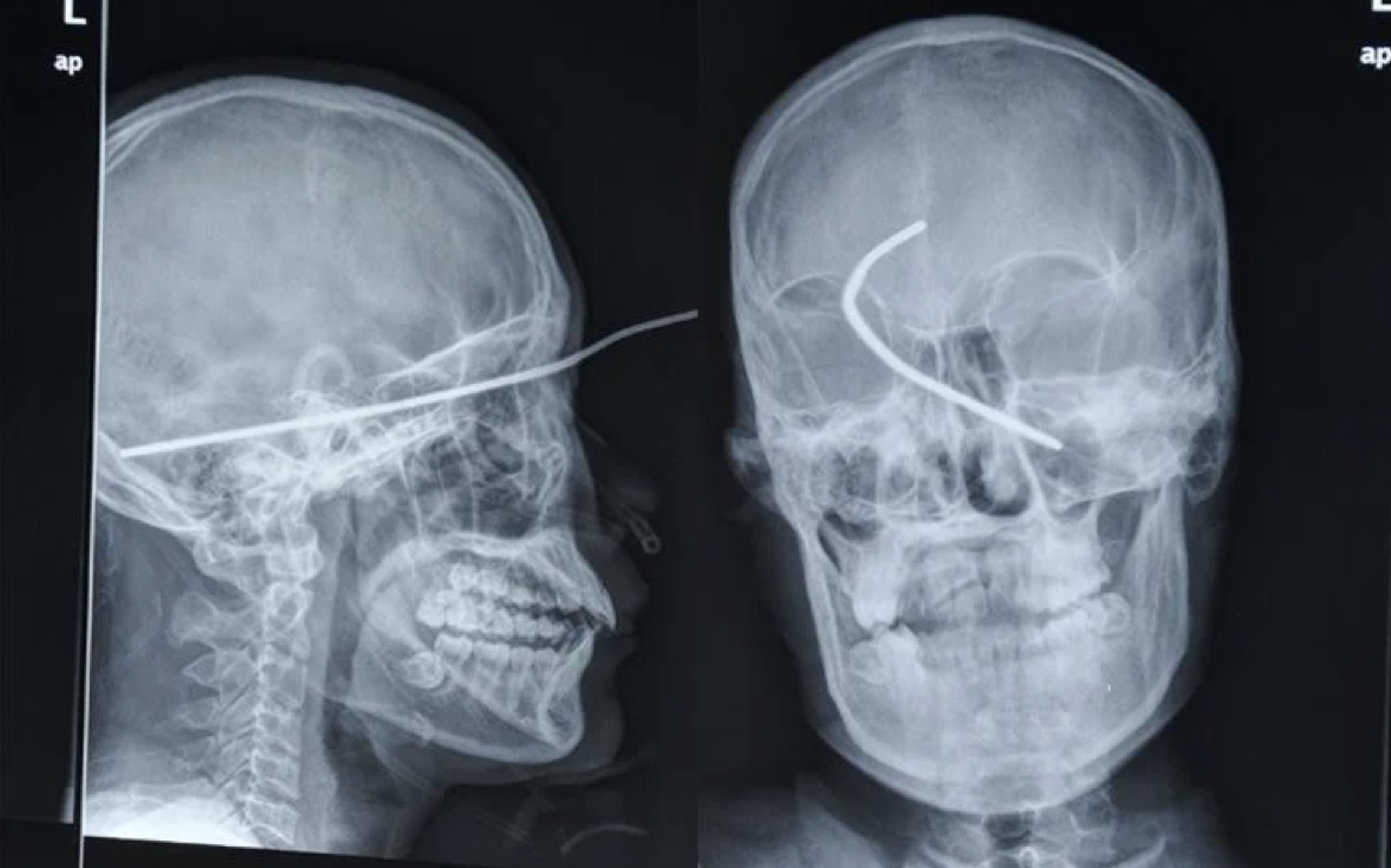 craziest xrays - ap L% ap