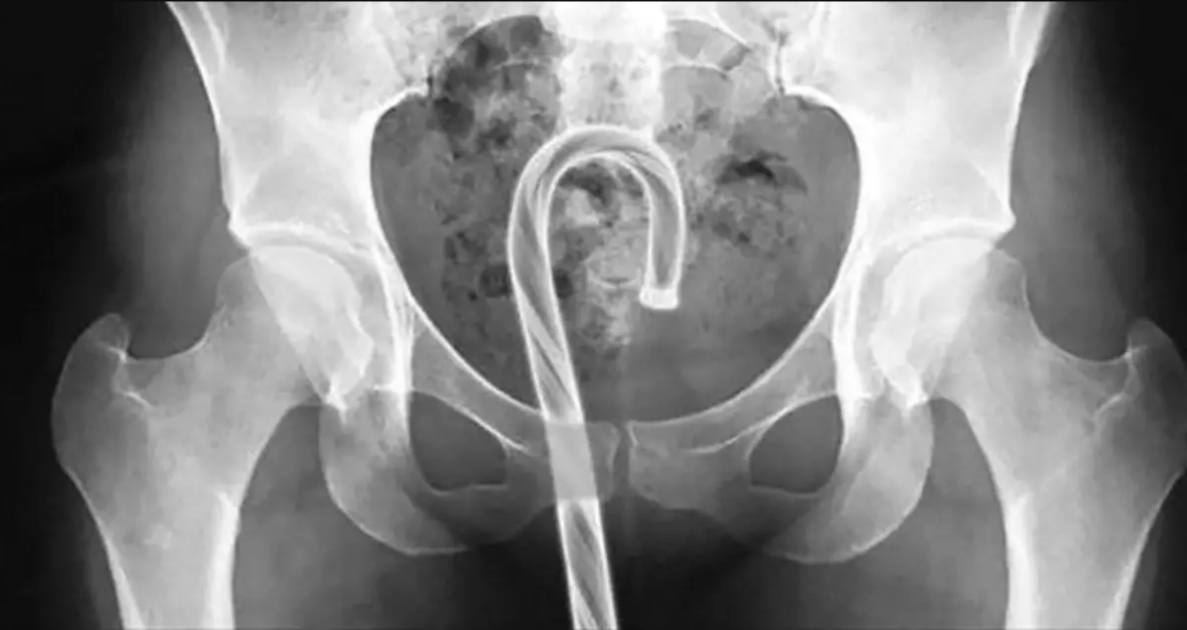 25 Crazy Things Seen in X-Rays