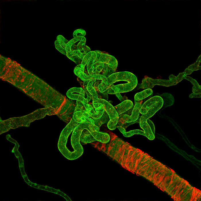 An Abnormal blood vessel formation in a human retina with severe diabetic retinopathy - Lions Eye Institute Physiology and Pharmacology laboratory, Nedlands, Western Australia, Australia