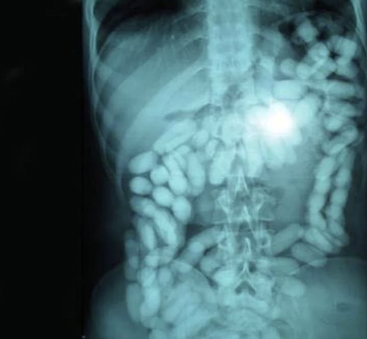 X-rays of drug mules.