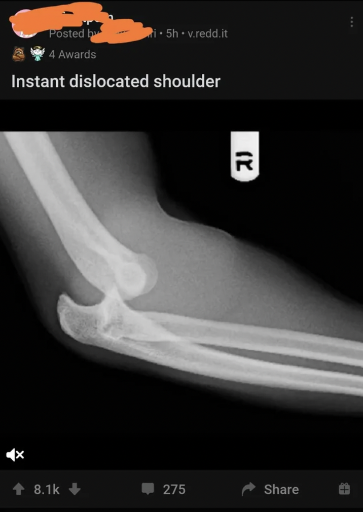 computed tomography - Posted b 1.5h.v.redd.it 4 Awards Instant dislocated shoulder R 275