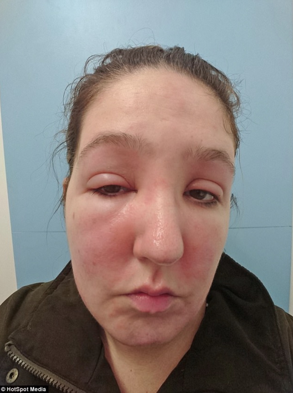 make up allergic reaction - HotSpot Media