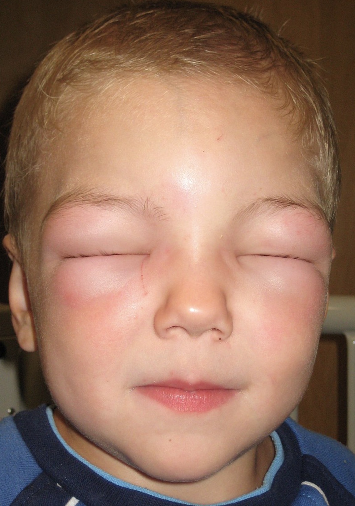 allergy in children