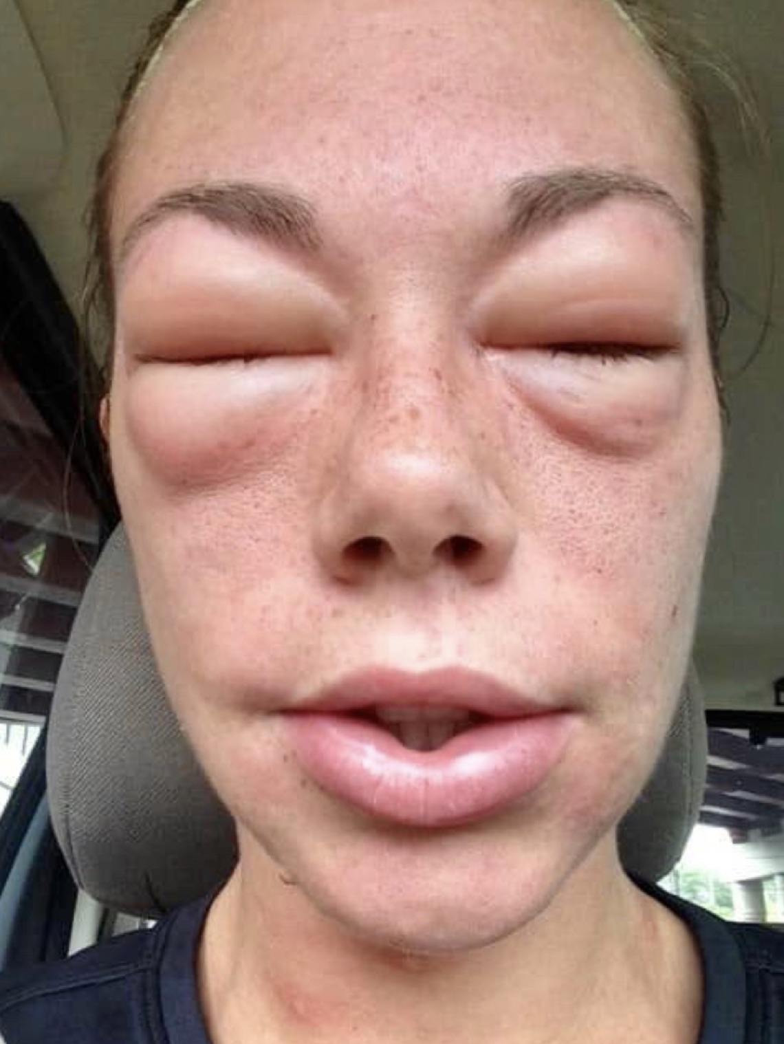 anaphylaxis face swelling