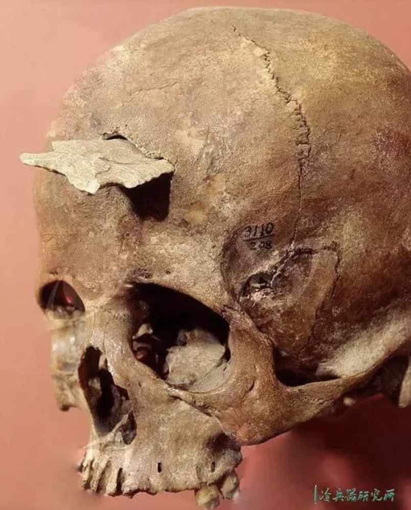 The skull of an Anasazi woman dating to the Pueblo I Period, (750 to 900 CE).