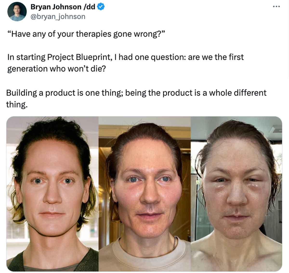 brian johnson face swollen - Bryan Johnson dd "Have any of your therapies gone wrong?" In starting Project Blueprint, I had one question are we the first generation who won't die? Building a product is one thing; being the product is a whole different thi