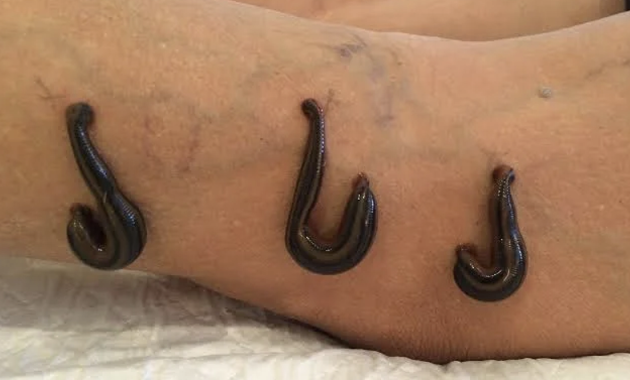 ayurveda leech therapy