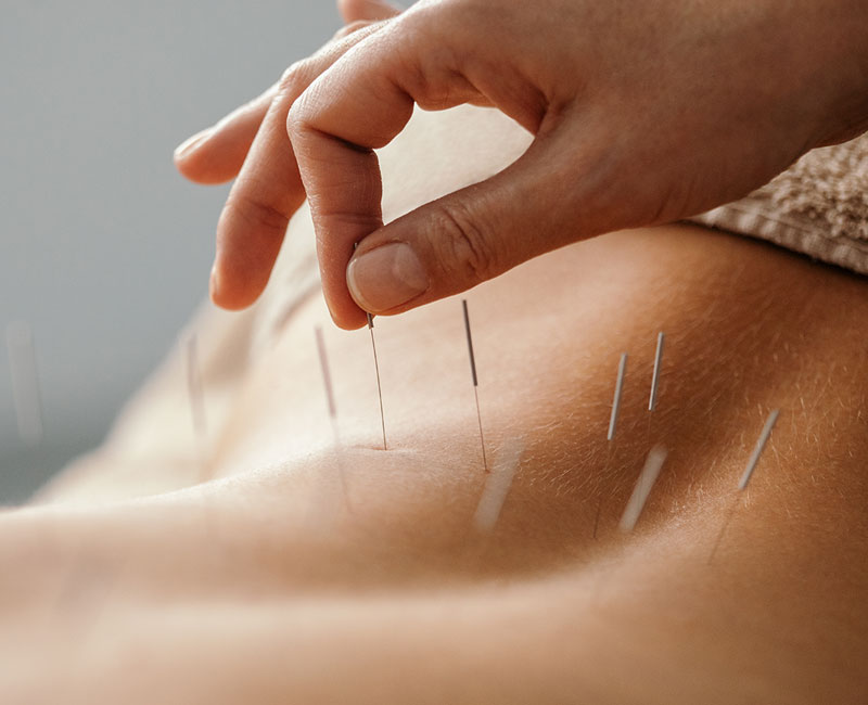 acupuncture treatment