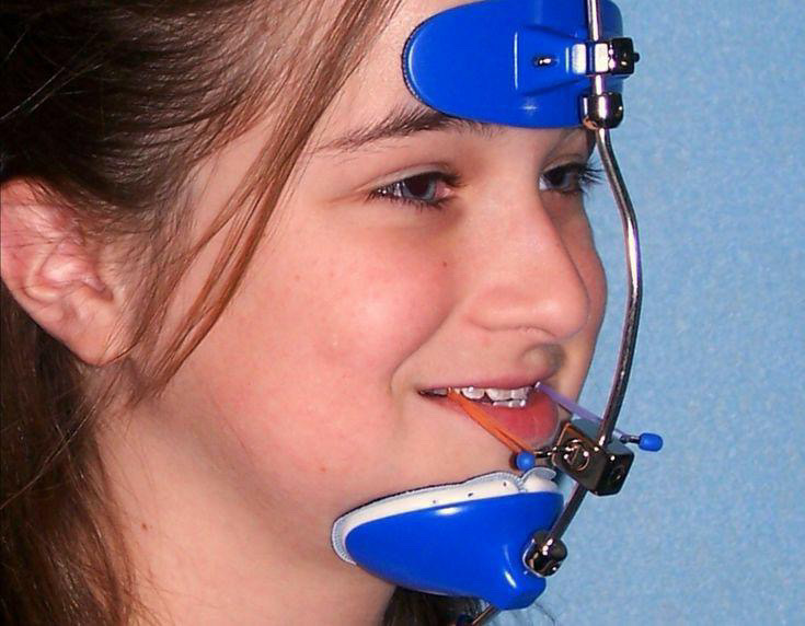 headgear orthodontic appliances