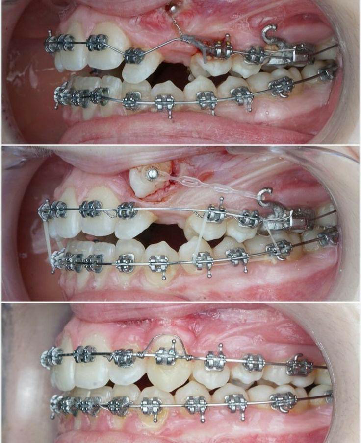 dental braces