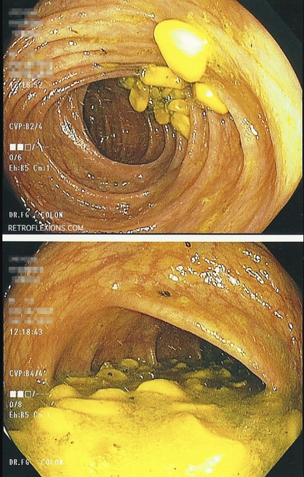 dosa - Cvp8274 06 Eh 85 C1 Dr.Ec Colon Retroflexions.Com 43 Cvp844 018 Eh85 Dr.Fg