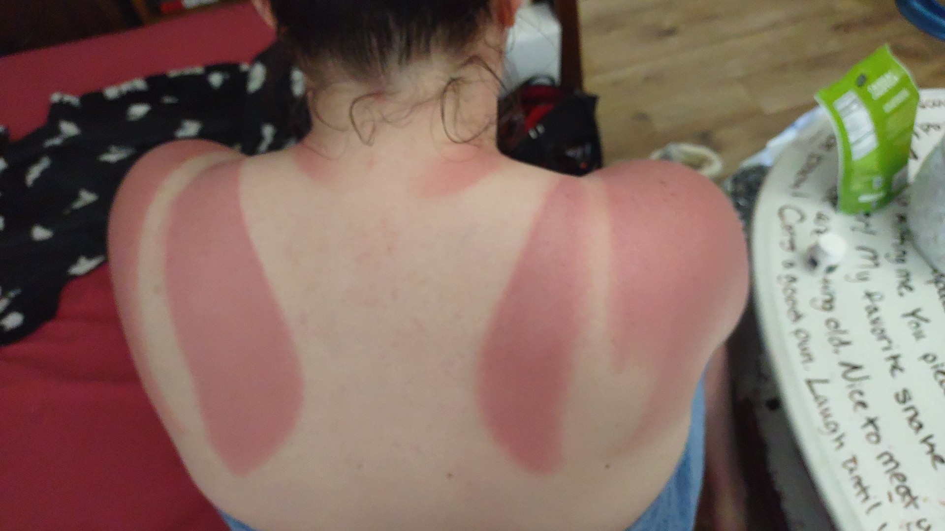 Skipping sunscreen after a brutal sunburn.