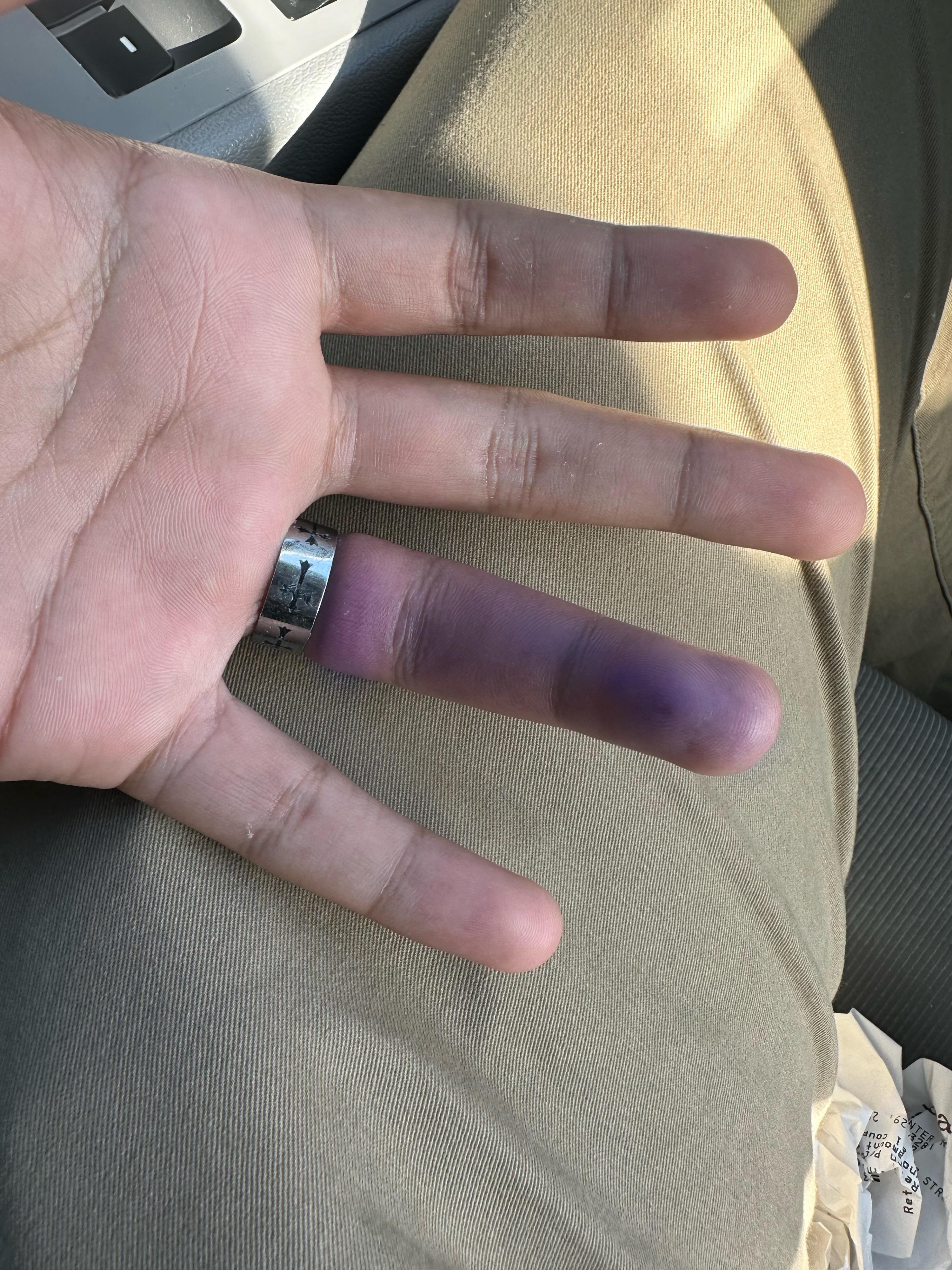 Fashion accessory turned medical emergency.