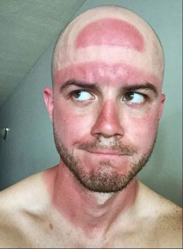 Sunburn? More Like Hatburn