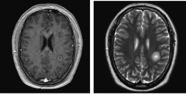 Spontaneous disease remission