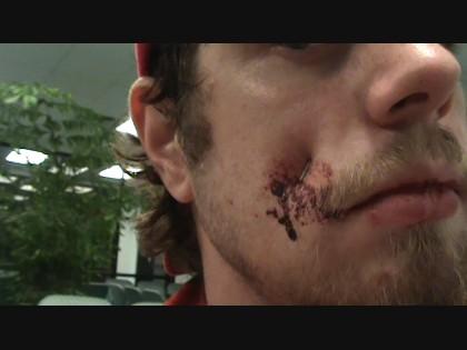 A Scean From The DDF Movie. Morton Gets A 3/4th Inch Staple Stuck In His Jaw Bone