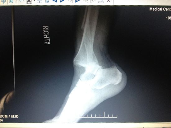 Ouch....Broken Ankle