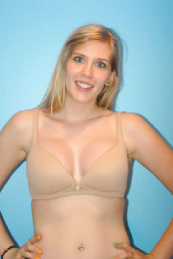 Before And After - Breast Implants