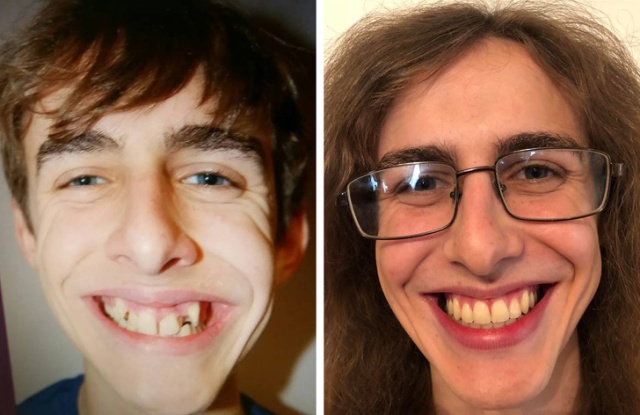 random before and after pics of someone with fixed teeth
