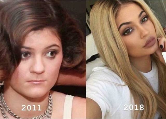 kylie jenner before surgery ugly - 2011 2018
