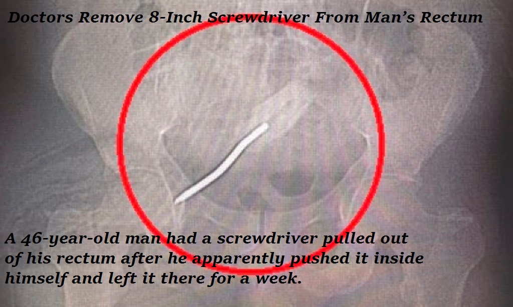 wtf jaw - Doctors Remove 8Inch Screwdriver From Man's Rectum A 46yearold man had a screwdriver pulled out of his rectum after he apparently pushed it inside himself and left it there for a week.
