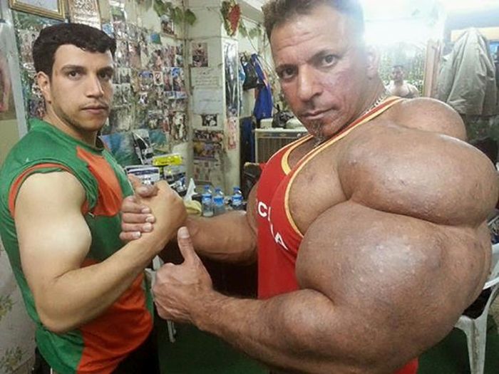 synthol in penis