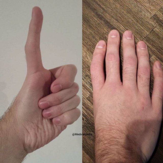 people with no fingers