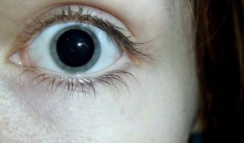 dilated pupils