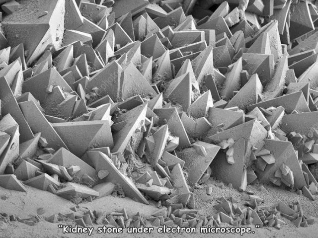 photo Libe Sch 20 "Kidney stone under electron microscope.