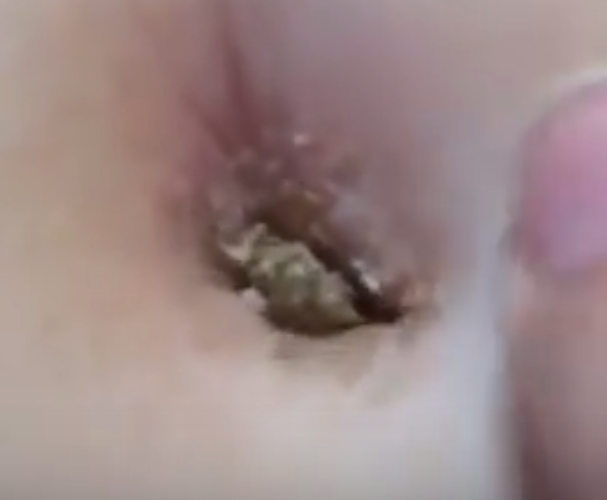 Jamie Davis of Moore, Oklahoma, noticed something odd in her sister’s belly button. Something that appeared to have hair.