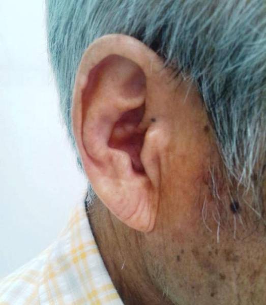 One research studied the association between diagonal earlobe creases and fatal cardiovascular disease, and it was found that 72% of men and 67% of women who died from a heart disease or heart attack displayed diagonal earlobe crease.