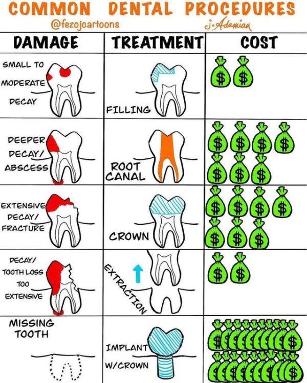 diagram - Common Dental Procedures jeAdamiau Damage Treatment Cost Small To $ Moderate Decay Filling Deeper Decay Abscess Root Canal Extensive Decay Fracture Wadi Crown Decay Tooth Loss Too Extensive Extraction Missing Tooth Selecc$ Implant WCrown