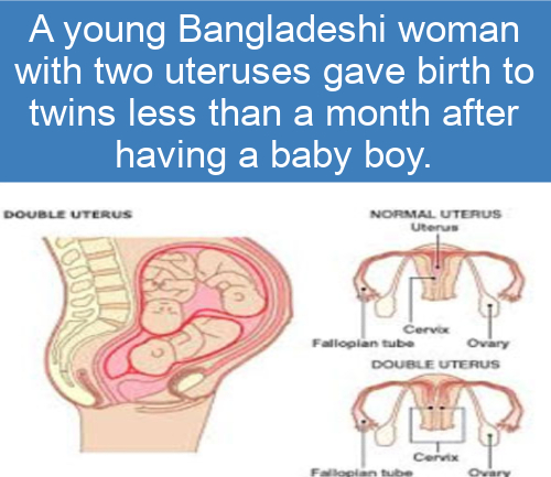 organ - A young Bangladeshi woman with two uteruses gave birth to twins less than a month after having a baby boy. Double Uterus Normal Uterus Uterus Cervo Fallopian tube Ovary Double Uterus