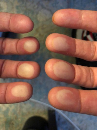 “Won’t be playing guitar for a while. Turned on the wrong burner and then grabbed a metal bowl that was sitting above the flame. Ouch. Yup. Those are blisters.”