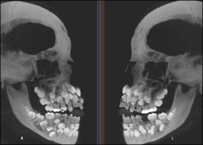 toddler skull x ray