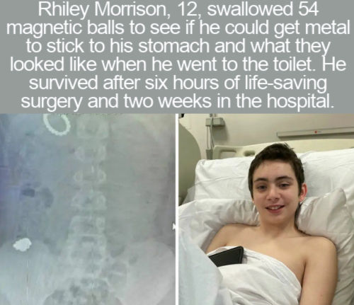 us bank - Rhiley Morrison, 12, swallowed 54 magnetic balls to see if he could get metal to stick to his stomach and what they looked when he went to the toilet. He survived after six hours of lifesaving, surgery and two weeks in the hospital.