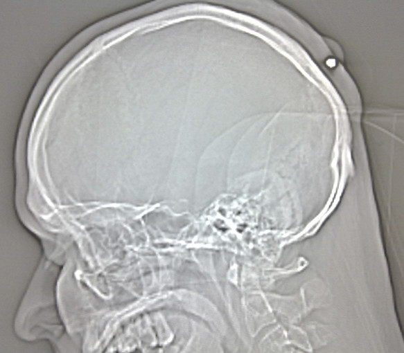.22 caliber found in mans head 5 years later