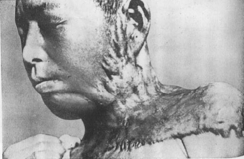 Japanese Atomic Bomb Victims
