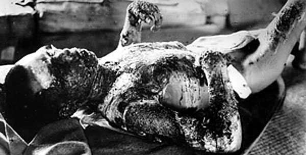 Japanese Atomic Bomb Victims