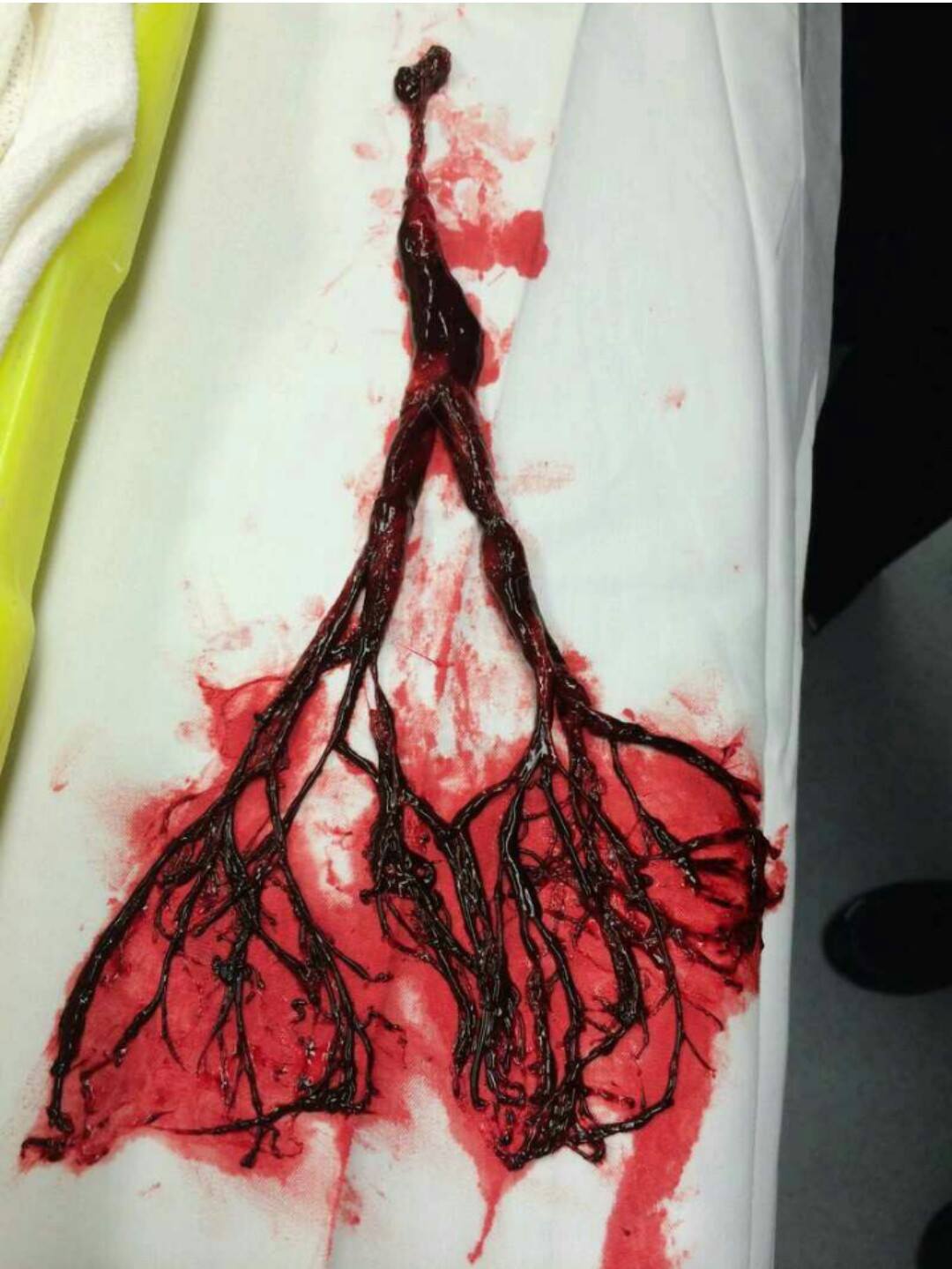 Entire lung blood clot