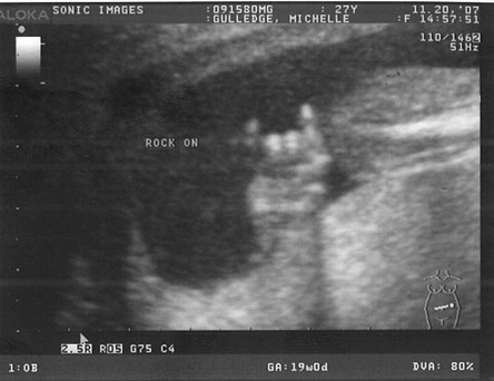 This kid is definatly going to be a rockstar. This is from an ultra-sound picture.
